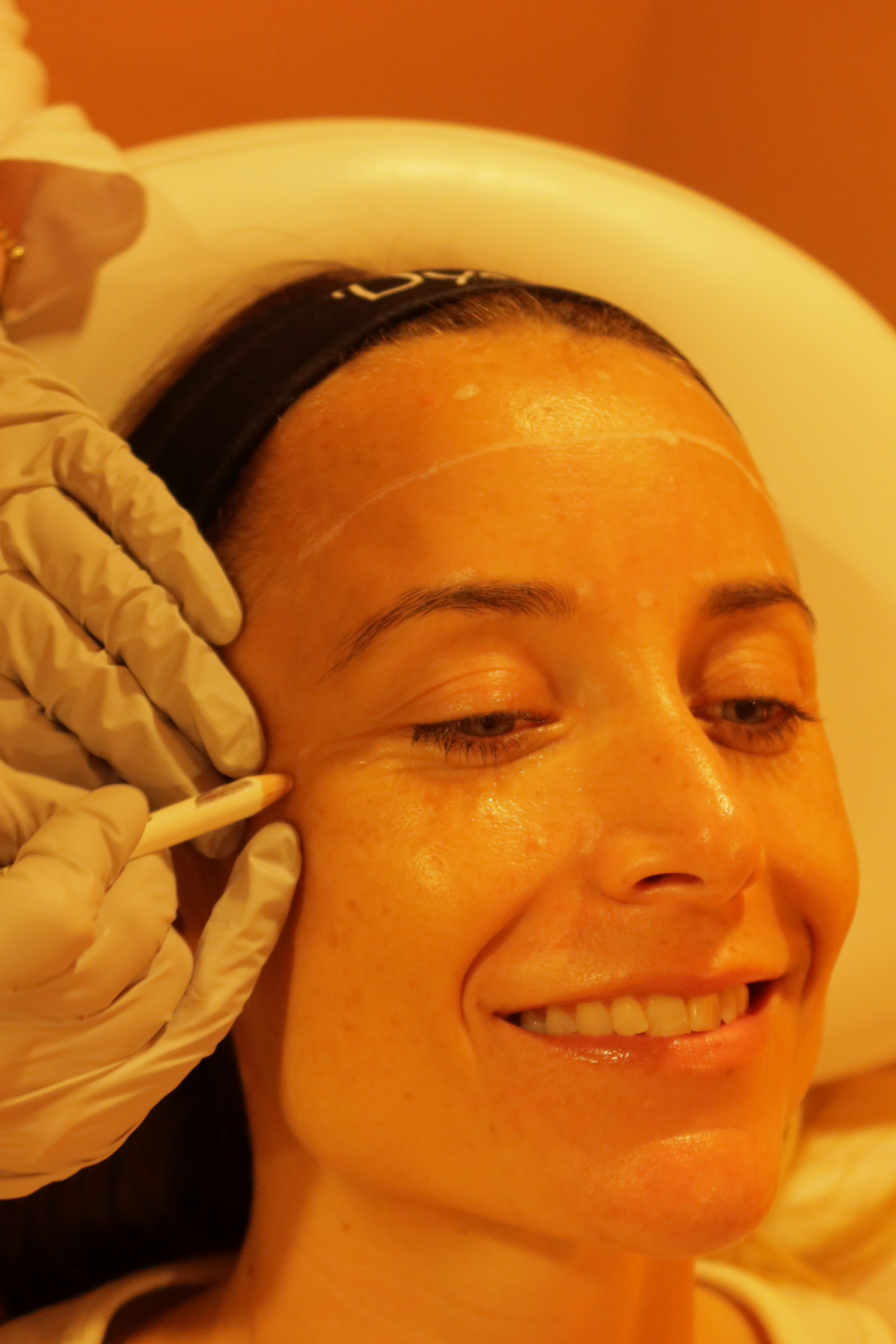 Hyaluronic Acid Fillers — By Area